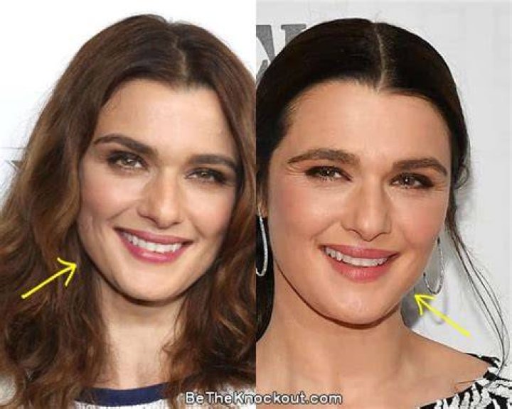Rachel Weisz Facelift Plastic Surgery Before and After ·